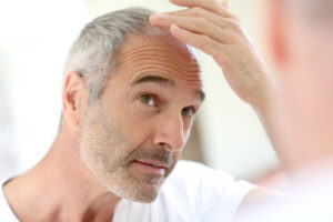 mature hairline